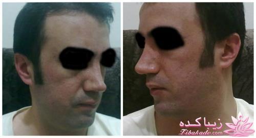 عمل زیبایی بینی برای بار دوم + عکس